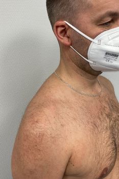 Bild Patient nach arthrokopischer Rotatorenmanschettenrekonstruktion
