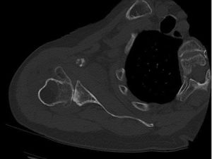 Bild Knochenausziehung am Oberarmkopf bei Arthrose