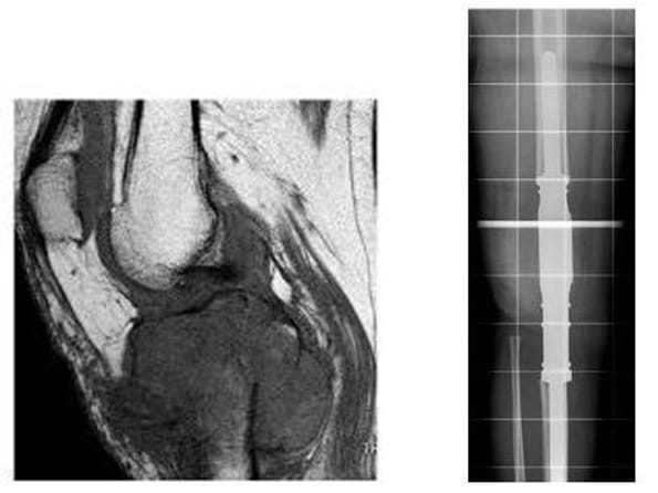 MRT-Bild eines Kniegelenkes mit Tumorbefall undRöntgenbild nach Tumorentfernung und Überbrückung des Defektes mit einem Arthrodesestab