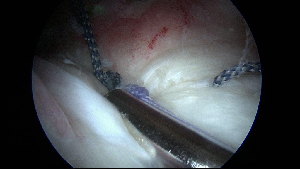 Bild arthroskopisches Nähen