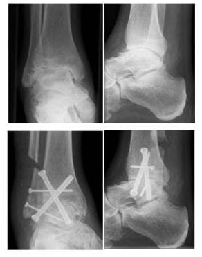 Röntgenbild oberen Bilder zeigen eine ausgeprägte Arthrose des oberen Sprunggelenkes unten sieht man die Versteifungsoperation