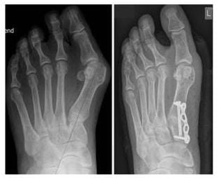 Röntgenbild Korrektur mit Lapidus Arthrodese