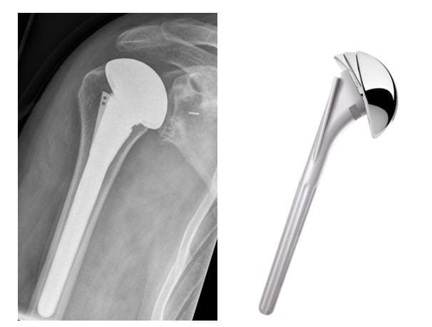 Röntgenbild anatomische Schulterprothese
