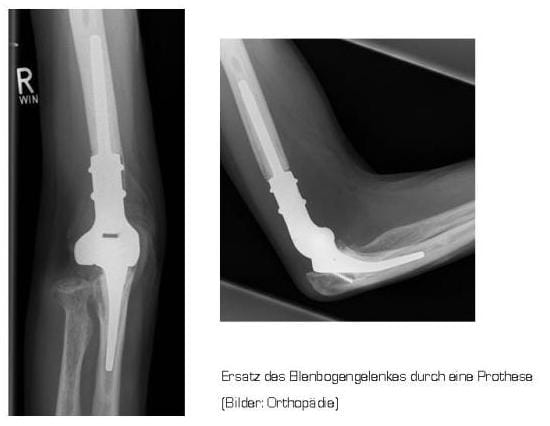 Röntgenbild Ellenbogengelenkersatz