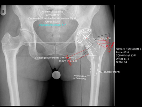Bild präoperative Planung Endoprothese links