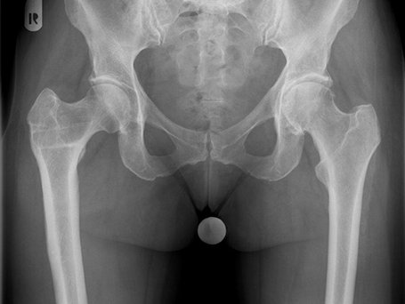 Bild linksseitige coxarthrose Umstellungsosteotomie rechts