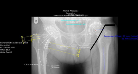 Bild Planung Hüftprothese links