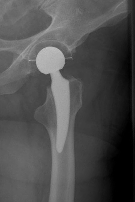 Bild coxarthrose links Ergebnis kurzschaft