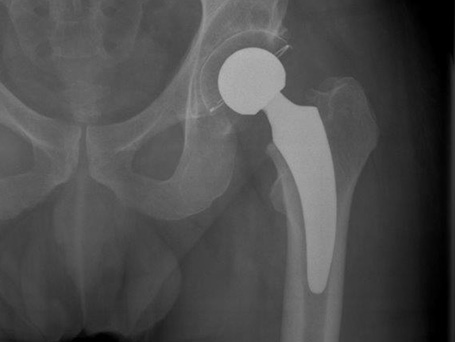 Bild coxarthrose links Ergebnis kurzschaft