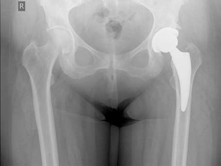 Bild Patientin Coxathrose Röntgen