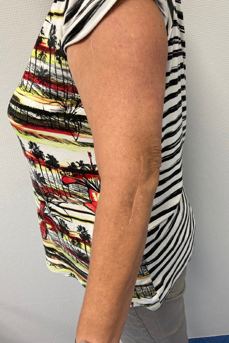 Bild Transolecranische Luxationsfraktur Arm der Patientin nach der OP