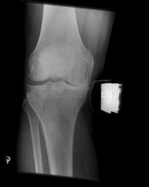 Bild mediale Arthrose