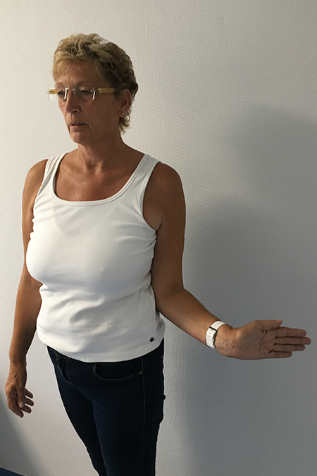 Bild Oberarmkopfnekrose Patientin macht Aussenrotation nach Hemiprothese