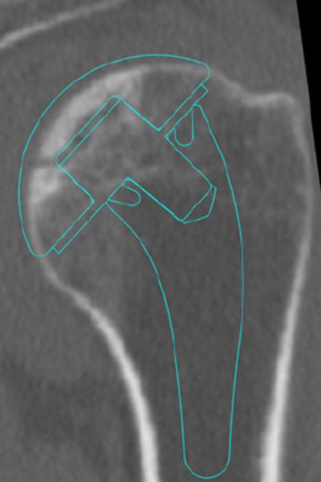 Bild Planung Hemiprothese