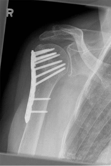 Bild nach Osteosynthese mit Knochentransplatation