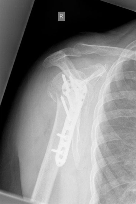Bild nach Osteosynthese mit Knochentransplatation