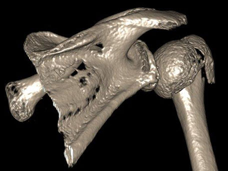 Bild Oberarmkopf Fragmentfraktur von Dorsal
