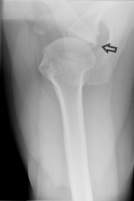 Bild postoperativ 6 Monate Span Dorsal eingeheilt
