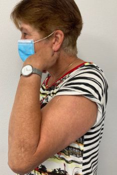 Bild Transolecranische Luxationsfraktur Patientin nach der OP