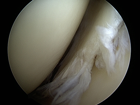 Bild deutliche Mehrfacheinrisse des Innenmeniskus im Knie Bild deutliche Mehrfacheinrisse des Innenmeniskus im Knie