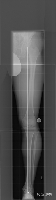 Bild HTO mit Tomofixplatte vor OP Bild HTO mit Tomofixplatte vor OP
